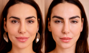 Lu Medical Transplante de Sobrancelha