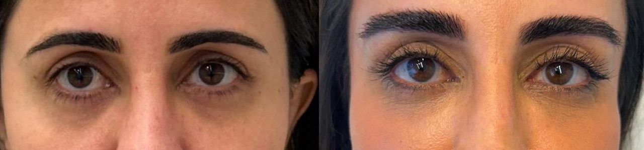 Lu Mackup Comparativos Antes e Depois