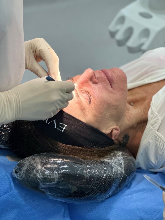 Lu Medical Everbrow Procedimento